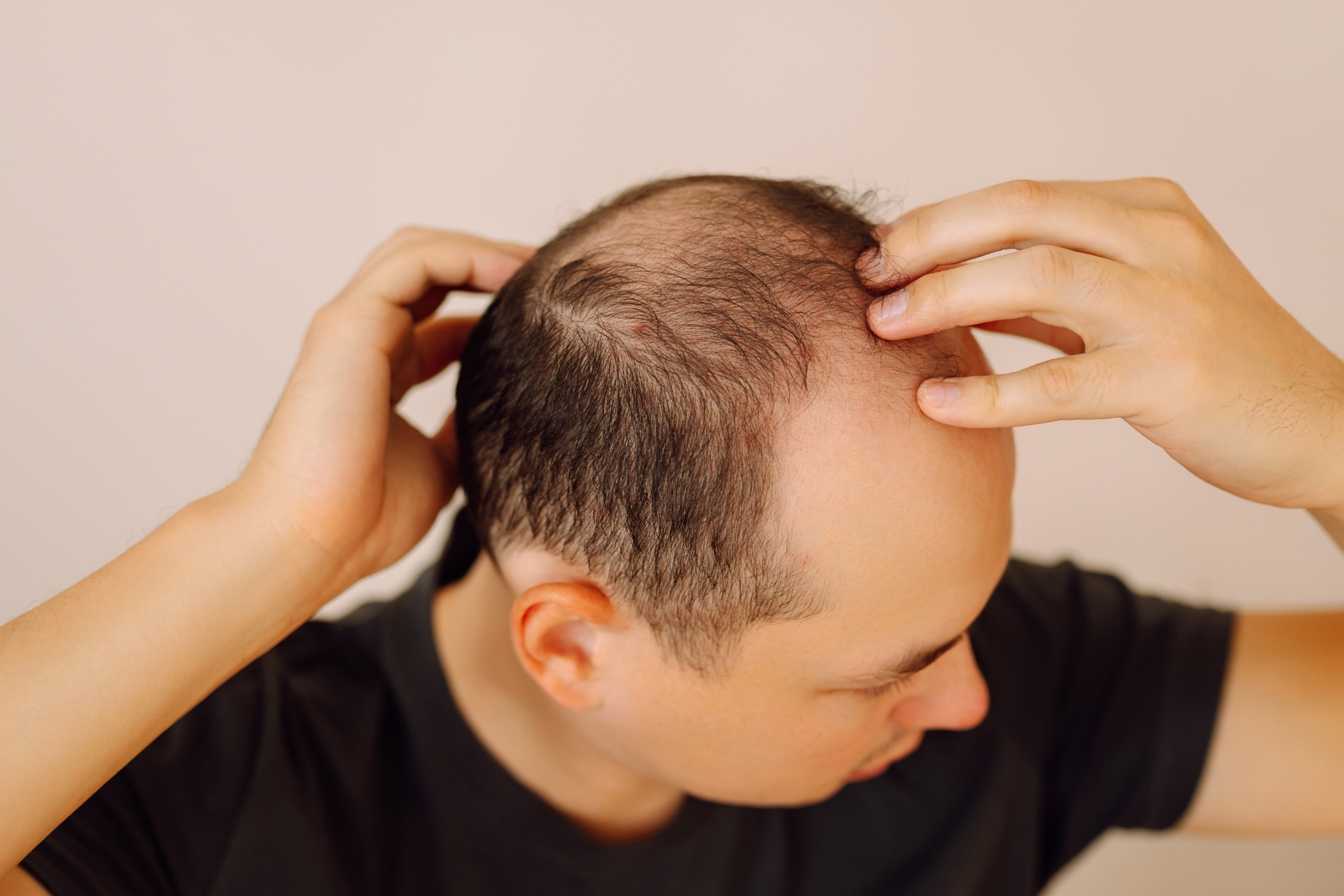 Alopécies localisées et diffuses : causes cicatricielles ou non, traitements médicaux et place de la greffe capillaire